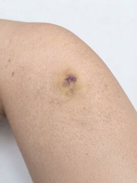 Close up of a visible bruise and contusion on human leg skin