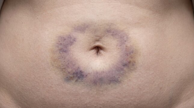 Periumbilical Ecchymosis &ndash; Non-Graphic Medical Science Background