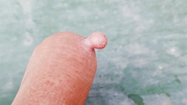 A small fleshy growth on the finger most often corresponds medically to a fibroepithelial polyp (commonly known as a skin tag or acrochordon). Consult a medical professional to confirm the diagnosis.