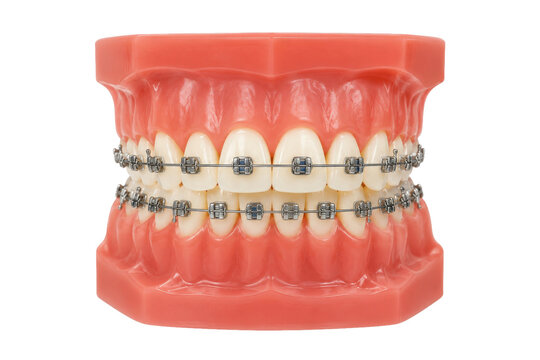 Dental model of human teeth with metal orthodontic braces isolated on a clean white background