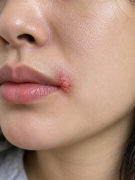 Cold sore with clustered blisters at corner of mouth
