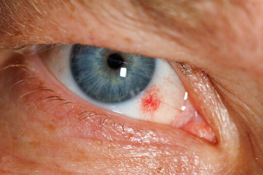 Close-up of human eye with red, inflamed area near pupil