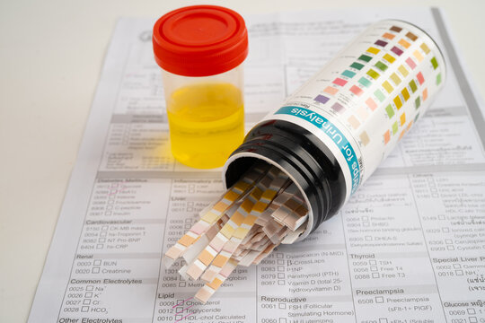 Urinalysis, urine cup with reagent strip pH paper test and comparison chart in laboratory.