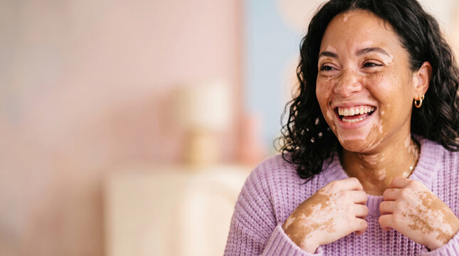 Woman with vitiligo happily laughing, embracing her unique skin condition with confidence and self acceptance, embodying positivity, diversity, and natural beauty