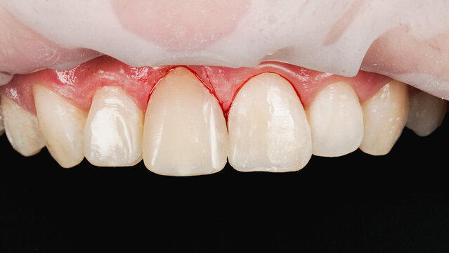 Close-up dental images showing gum bleeding and common dental treatments, including dental implants, veneers, tooth restoration and oral care. Clinical dentistry concept focused on gum health
