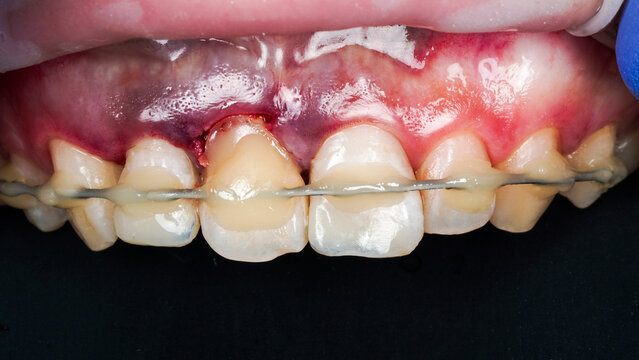 Close-up clinical images showing fixed orthodontic braces on upper teeth with visible gum inflammation and bleeding. Dental treatment focused on tooth alignment, orthodontic correction