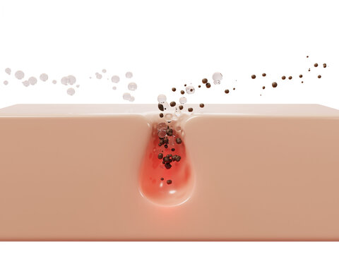 Acne skin care, 3d pore with red inflammation, dirt particles and clear gel cleanser drops. Blackhead pimple treatment. Liquid cosmetic bubbles of retinol serum, salicylic acid lotion