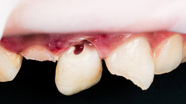Close-up clinical view of traumatic injury to the upper front teeth, showing a fractured and displaced tooth with bleeding and damaged gum tissue. Dental trauma requiring examination