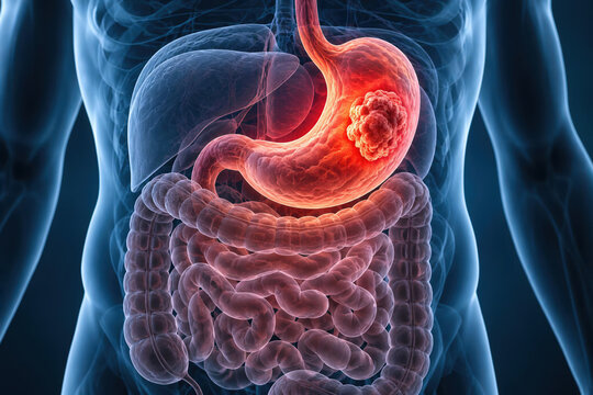Stomach tumor and digestive cancer illustration showing gastric tumor in gastrointestinal system stomach pain digestive symptoms cancer diagnosis medical healthcare concept visualization