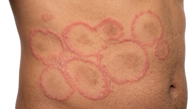 Close up of male torso displaying multiple circular red rashes caused by ringworm tinea fungal infection