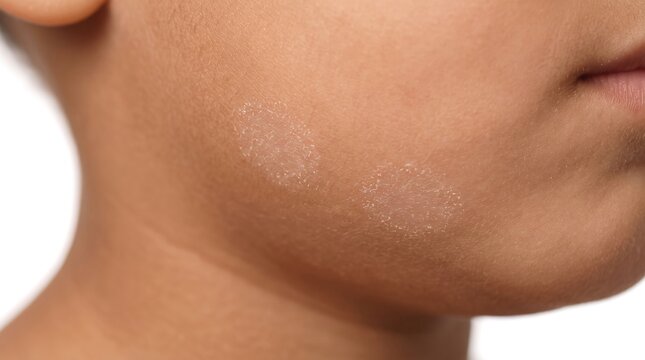Close up of child jaw and cheek showing circular scaly red rash typical of ringworm tinea corporis or nummular eczema