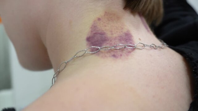 Woman's neck with a purple bruise from cupping. Hijama mark. Black top, back view.