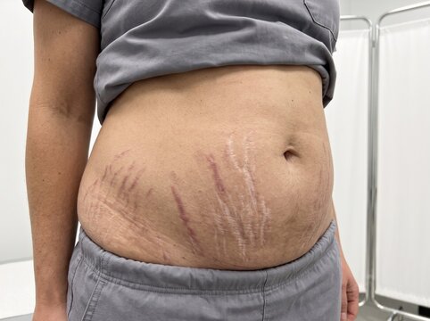 Abdominal Striae Distensae (Stretch Marks)