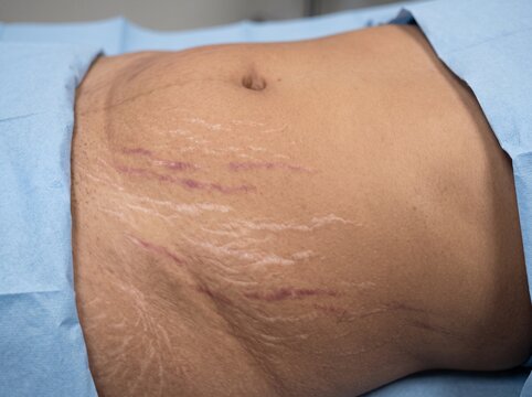 Striae Distensae 