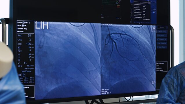 Close-up of X-ray screen showing coronary arteries on angiography, interventional cardiology imaging for heart disease diagnosis. Medical background