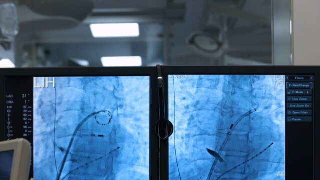 Fluoroscopy monitors showing cardiac catheters and electrodes during electrophysiology procedure, cath lab control room with operating room behind glass. X-ray screens in hospital catheterization lab