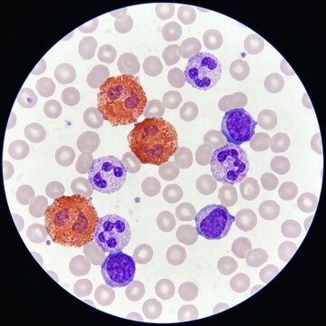 Illustrative image of eusinophylls and other blood cells seen through a microscopy	