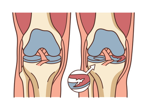 Illustration showing healthy knee joint compared to a meniscus tear with zoomed detail sports injury medical illustration anatomy chart joint pain medical diagram injury recovery orthopedic sur