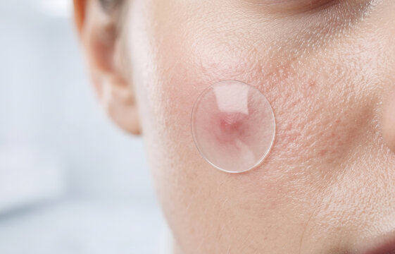Macro Detail of Transparent Pimple Patch Healing an Inflamed Zit