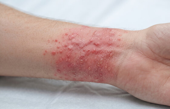 Close Up of Severe Poison Ivy Contact Dermatitis and Blistering Rash on Forearm