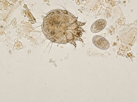 Scabies Mite and Eggs Under Light Microscope