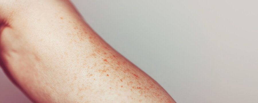 Human arm showing numerous freckles and pigmented spots on light skin, a dermatology and aging skin concept