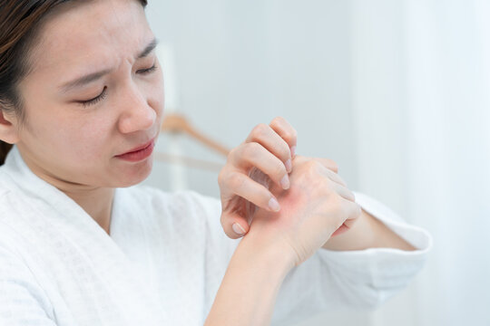 skin problem and beauty. Young woman scratch body has itchy skin from skin allergic, steroid allergy, sensitive skin, red from sunburn, chemical allergy, rash, insect bites, Seborrheic Dermatitis.