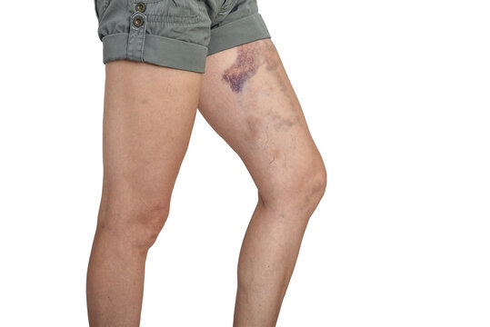 Woman's legs in shorts with  bruise following thigh muscle injury. White background, isolated