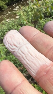   
Close-up of frostbitten white finger, winter cold injury, human hand detail showing frozen skin tone, medical and survival concept in harsh environment