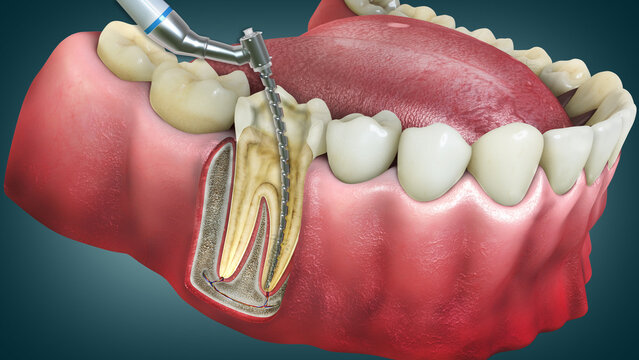 Endodontic root canal treatment. An advanced endodontic file is in action. It removes the infected enamel, dentin and some parts of the pulp tissue.