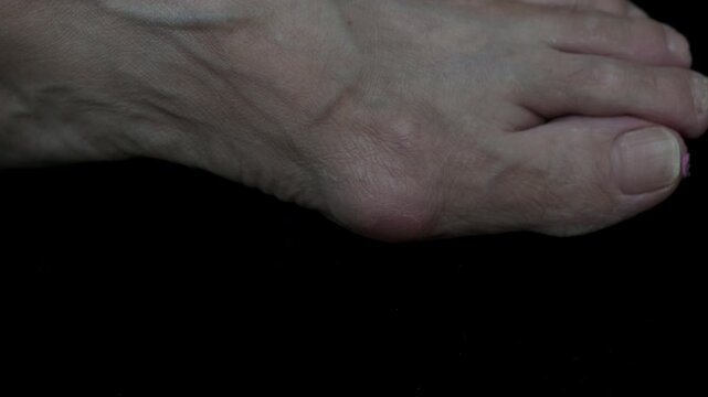 4K macro rotating view of Hallux valgus, showing big toe deviation and forefoot deformity. Also known as bunion, involving Hallux and Os metatarsale I.