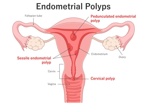 Endometrial polyps types. Pedunculated and Sessile polyps. Medical illustration. Uterus cross section.