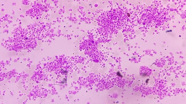 Thrombocytosis. Platelet increased in number. Microscopic footage of  complete blood count (CBC). 