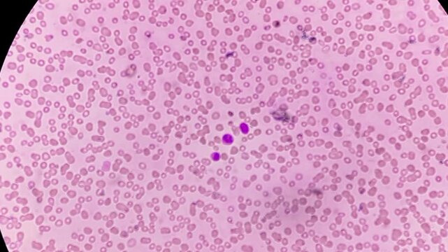 Acute leukaemia (AL). Microscopic footage. WBC shows left shift, atypical looking large mononuclear cells with 1-2 nucleoli.