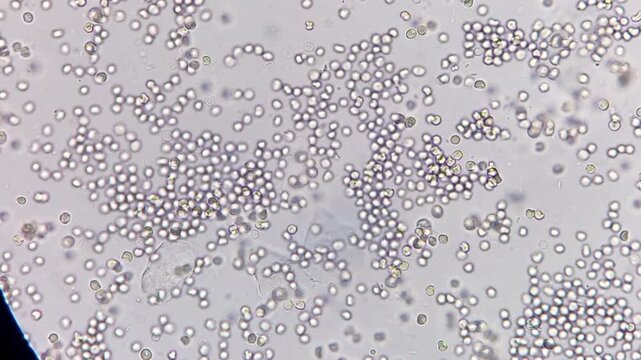 Microscopic footage of urinalysis showing plenty Red blood cells (RBC).