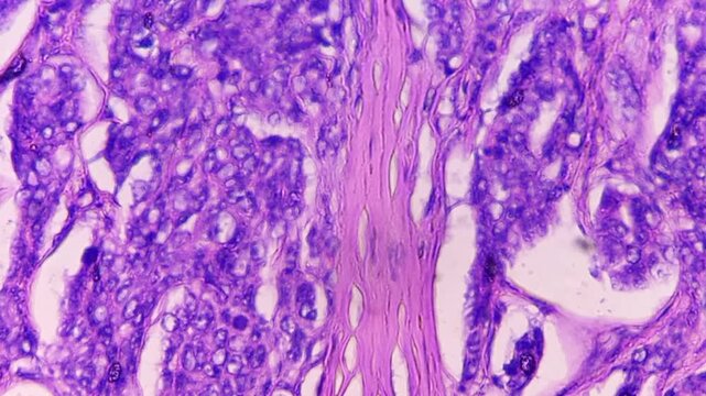 Histopathology of right breast lump. Infiltrating ductal carcinoma (nst), well differentiated G-1. Section of breast tumour reveal features of an infiltrating ductal carcinoma. 