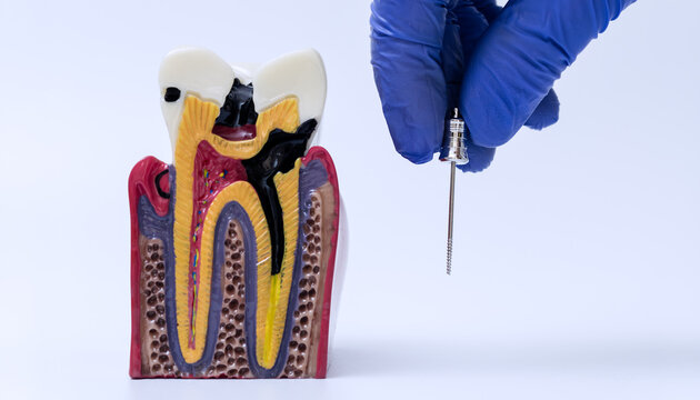 Root canal treatment education concept with dentist hand holding endodontic instrument near anatomical cross section model of decayed tooth.