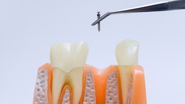 Orthodontic miniscrew placement concept with precision dental tweezers above anatomical teeth and gingiva model