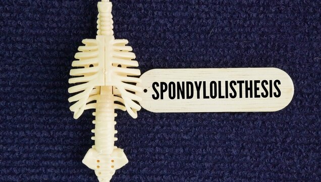 Human spine and paper with words Spondylolisthesis is a spinal condition where one vertebra slips out of place and over the bone below it.