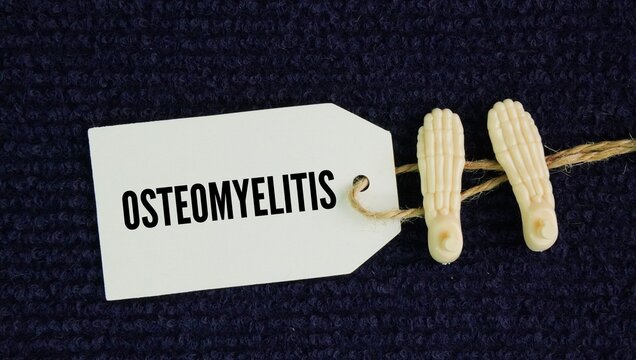 Human leg bones and paper tags with the word Osteomyelitis is a serious infection and inflammation of the bone and bone marrow, usually caused by bacteria or fungi