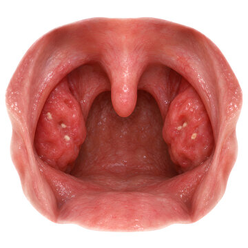 Moderate tonsillitis in palatine tonsils, isolated photorealistic 3D oropharynx anatomy render showing swollen red tissue and crypt exudate for ENT training, healthcare design and patient education