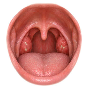 Moderate tonsillitis in palatine tonsils, isolated photorealistic 3D oropharynx anatomy render showing swollen red tissue and crypt exudate for ENT training, healthcare design and patient education