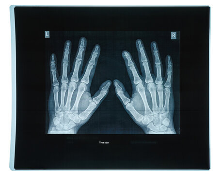 X-ray film of both human hands showing bones, joints and fingers