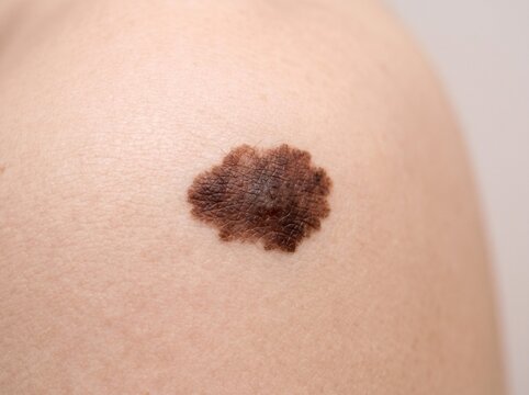 Close-Up of Irregular Asymmetric Mole on Skin