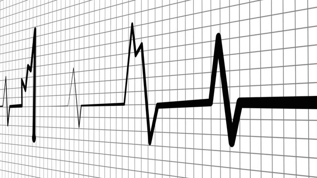Abnormal heart rhythm line showing an ekg style medical waveform animation