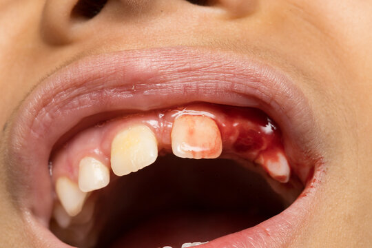 Child experiencing severe dental trauma with bleeding gums