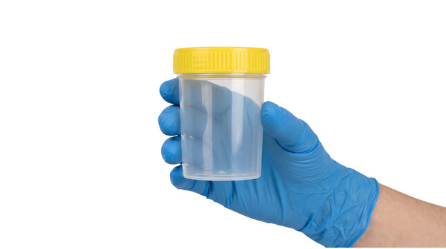 Gloved hand holding empty urine specimen container with yellow cap for laboratory urinalysis, medical testing and health checkup, isolated on transparent background