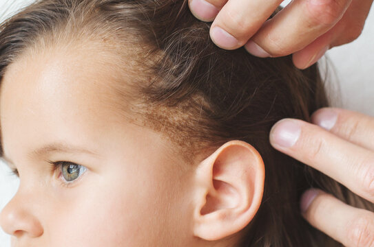 Adult hands parting hair of child with green eyes showing yellow crusts on scalp near ear, seborrheic dermatitis, cradle cap, concept of pediatric dermatology, children skin care, treatment