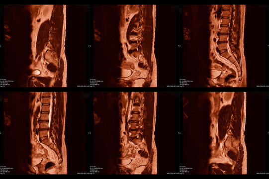 spine lumbar vertebrae x-ray images shows Herniated disc disease. 