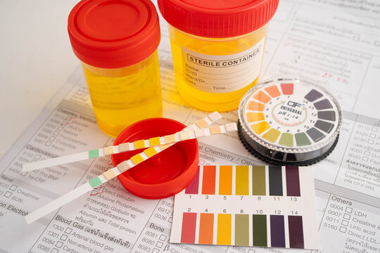 Urinalysis, urine cup with reagent strip pH paper test and comparison chart in laboratory.